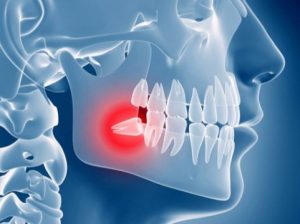 عوارض جراحی دندان عقل