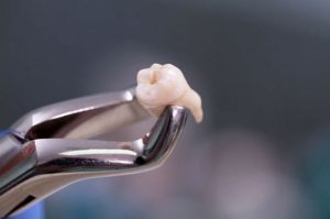 علل جراحی دندان عقل