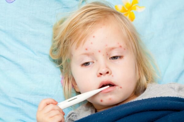 علت ایجاد آبله مرغان