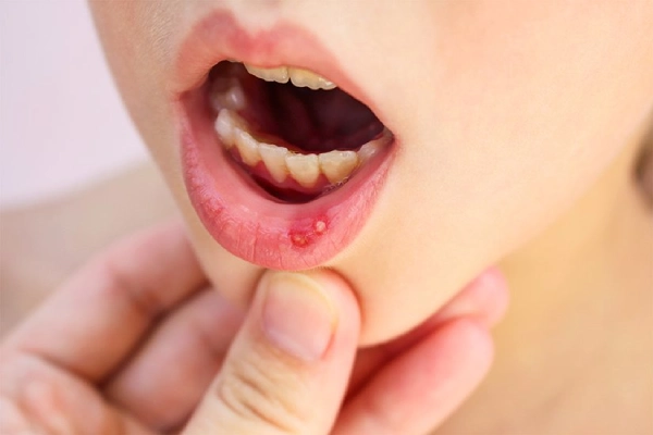 دلیل ایجاد آفت دهان کودک و روش درمان آن