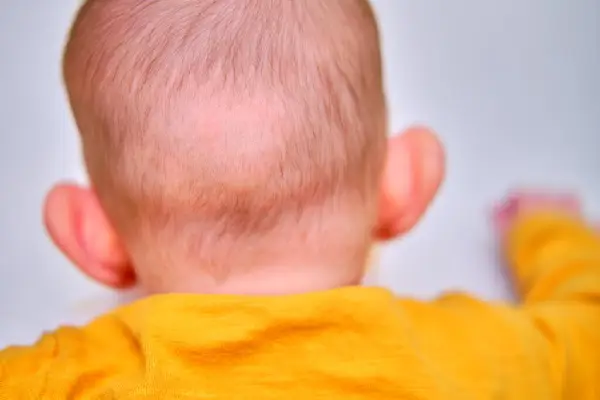 دلایل، پیشگیری و درمان ریزش مو در کودکان